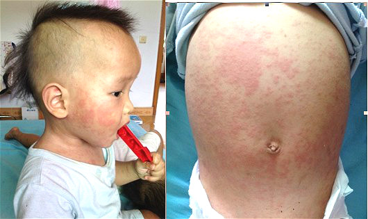 幼儿急疹会引起高热惊厥吗,小孩发烧39.7高温惊厥