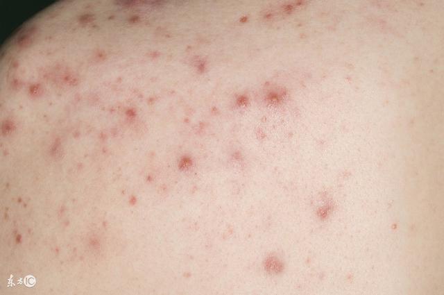 丘疹怎么护理才好得快,丘疹需要关注的饮食
