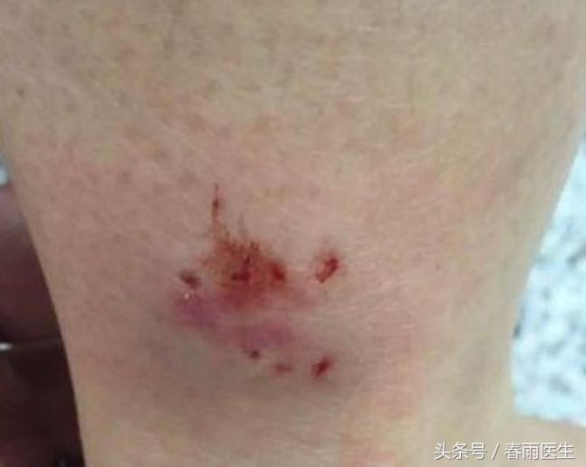 被狗咬了打了狂犬病疫苗会有事吗,被狗咬后狂犬疫苗只打一针可以吗