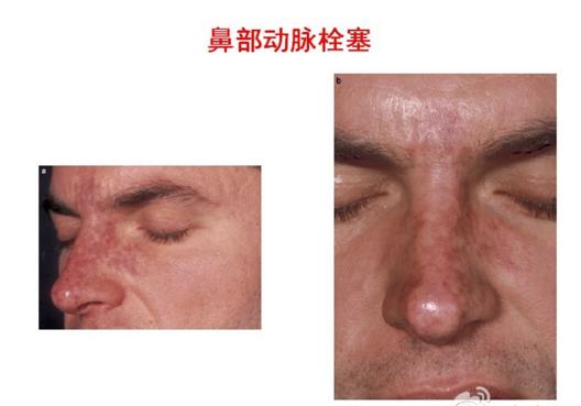 面部注射后血管栓塞图,面部注射栓塞的视频