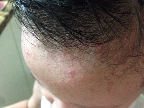 痱子喷雾止痒婴儿,专门治痱子的花露水