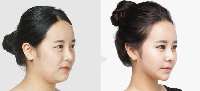 脸部训练器能减掉双下巴吗,怎么减掉脸上的肉和双下巴