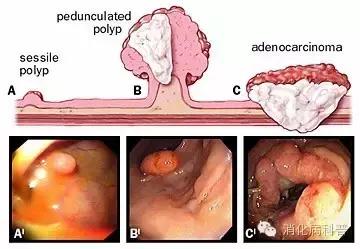 胃镜息肉切除后多久复查一次,体检检查出来胃息肉怎么办