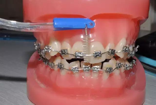 戴牙套如何清洁,牙套的清洁推荐