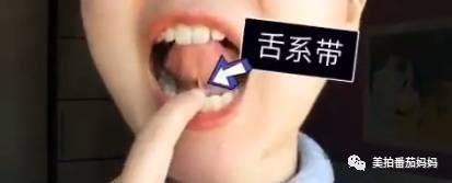 12岁孩子说话不清楚舌系带过短,2周岁8个月舌系带过短要不要剪