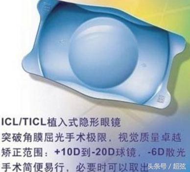 icl晶体植入最大多少度近视,icl晶体植入未来还会近视吗