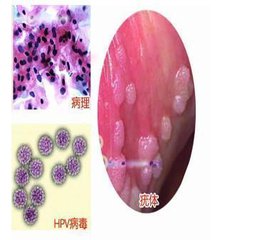 人工干扰素治疗hpv感染效果怎么样,hpv感染身上长了好多疣体怎么治疗