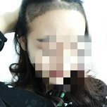 大额头适合用什么植发,大额头发际线高怎么办