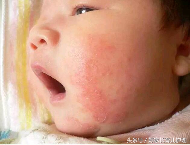 宝宝湿疹医生开什么药,宝宝湿疹怎么给宝妈解释
