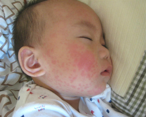 幼儿急疹会引起高热惊厥吗,小孩发烧39.7高温惊厥