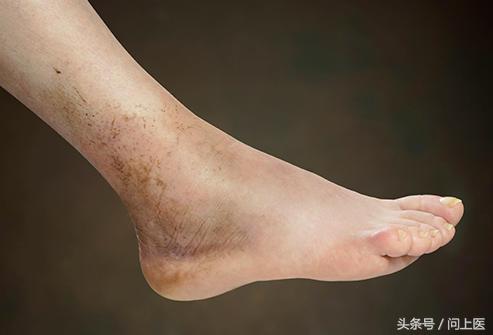 脚疼痛麻木脚肿什么原因,肢体麻木全身刺痛是怎么缓解