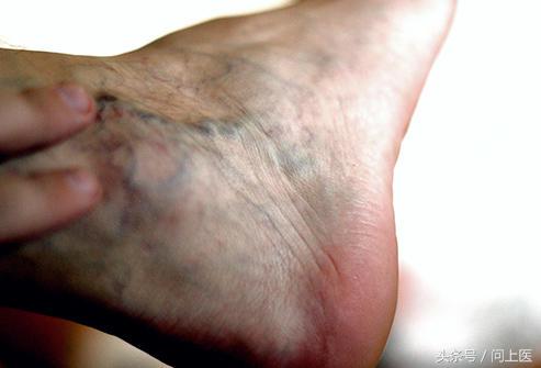 脚疼痛麻木脚肿什么原因,肢体麻木全身刺痛是怎么缓解