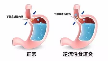 烧心感是什么感觉,心口嘈杂烧心是什么原因