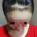 大额头适合用什么植发,大额头发际线高怎么办