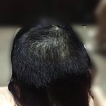 大额头适合用什么植发,大额头发际线高怎么办