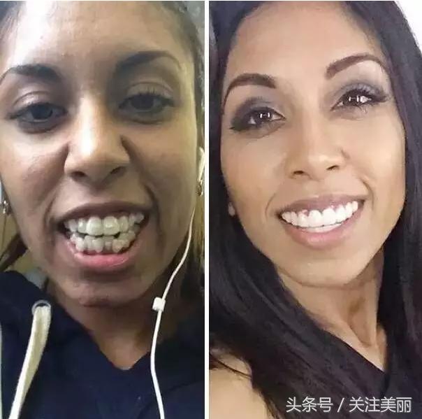 戴了牙套后嘴唇会变薄吗,戴牙套后会导致嘴变凸吗