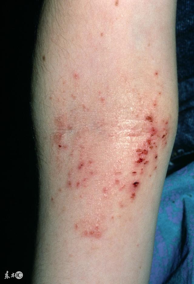 过敏性皮炎很难缠中医来帮你排忧解难