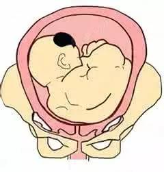 几种胎位不正需要剖腹产,正确胎位和臀位