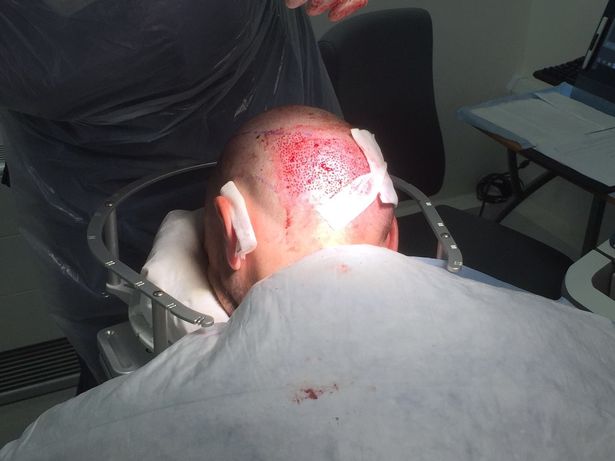 英国球星鲁尼植发,鲁尼植发真实视频