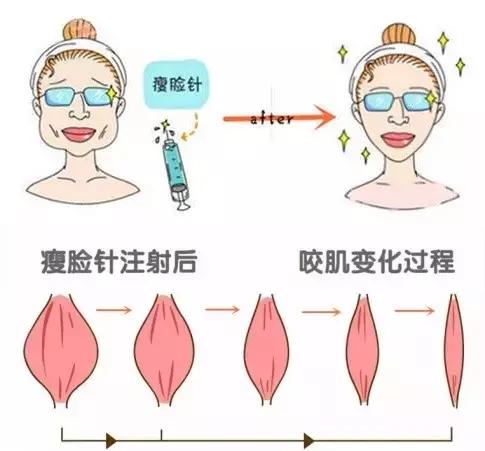 打瘦脸针与不打瘦脸针的区别,为什么打瘦脸针没有效果呢
