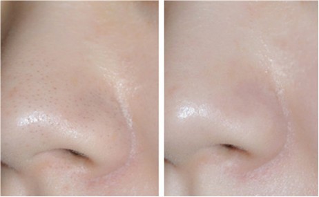 李士黑头导出液怎么用,黑头导出液刺痛怎么回事