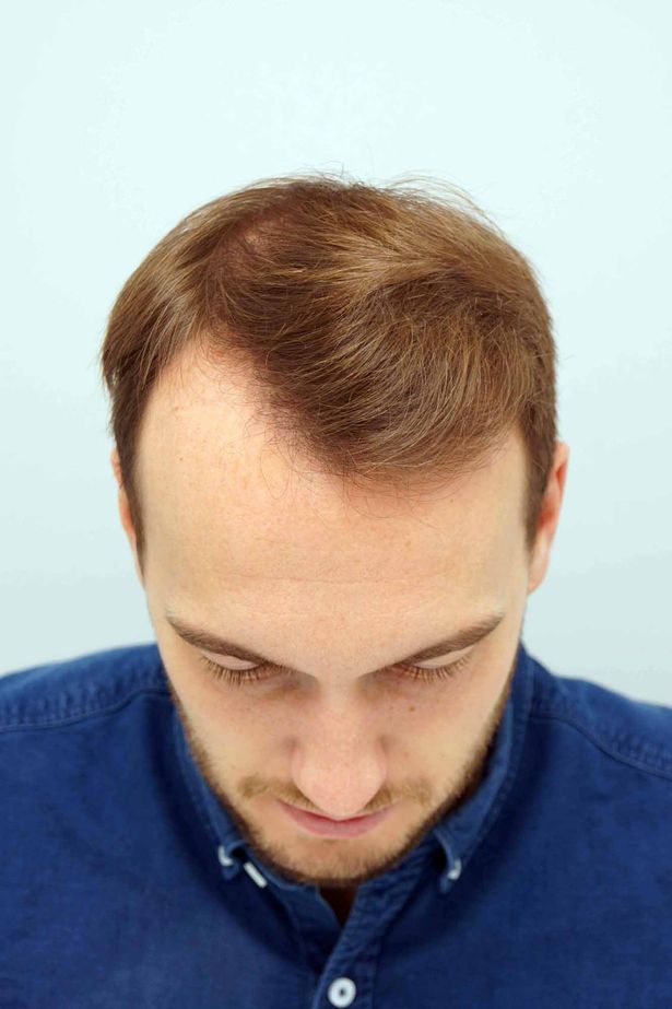 英国球星鲁尼植发,鲁尼植发真实视频