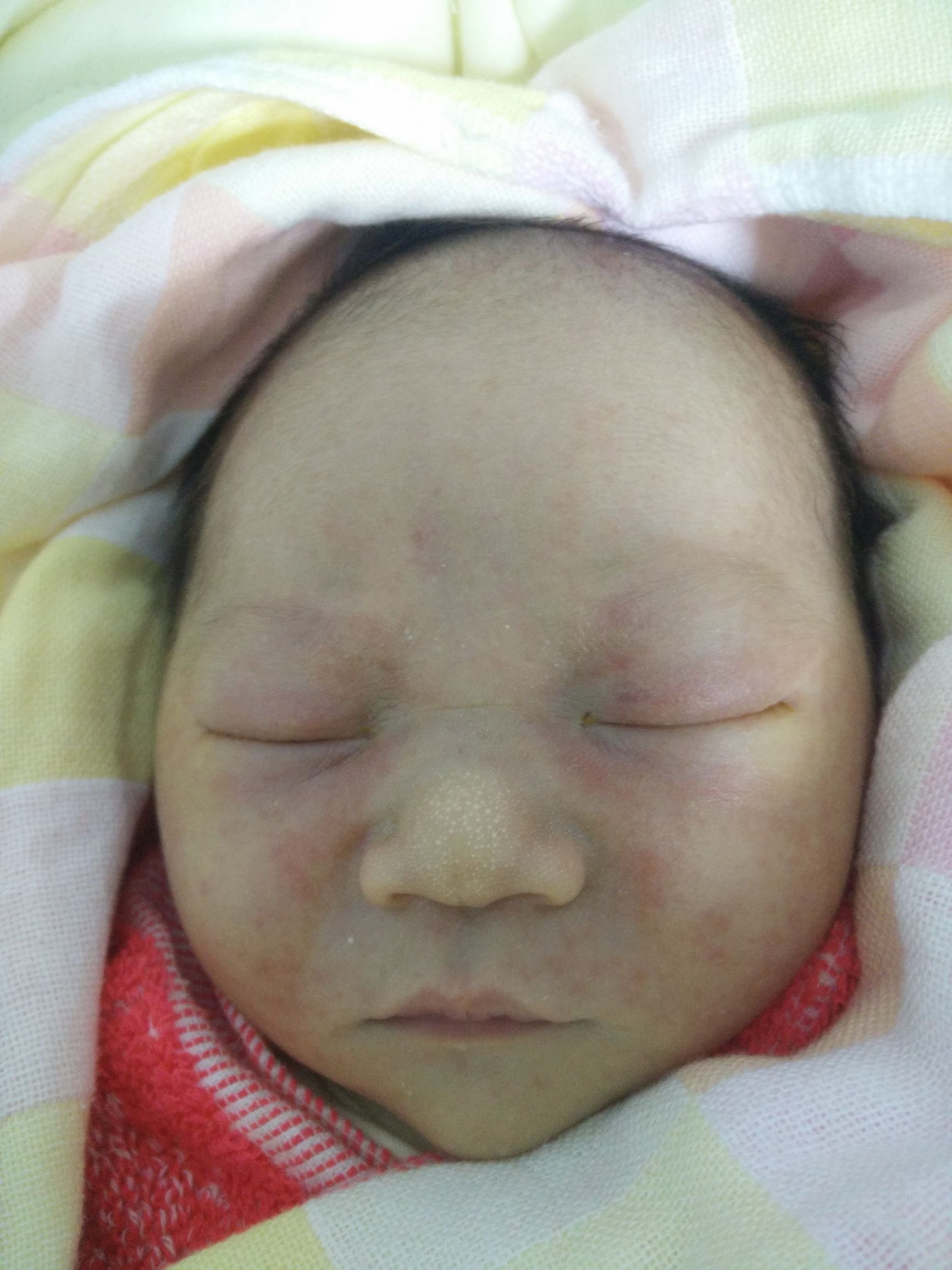 宝宝湿疹妈妈很着急,宝宝湿疹的正确防治方法