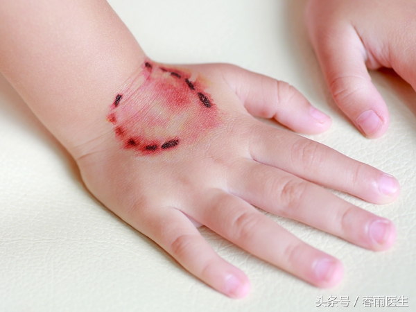 被狗咬了打了狂犬病疫苗会有事吗,被狗咬后狂犬疫苗只打一针可以吗