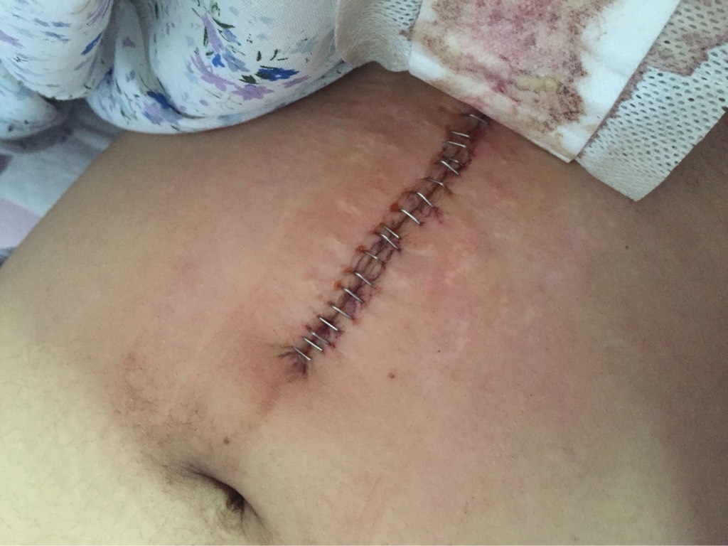 宝妈剖宫产伤口护理正确的方法,剖腹产伤口裂开二次缝合怎么做