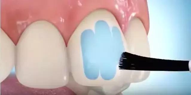 箍牙的牙套是怎么固定上去的,箍牙齿全过程图片