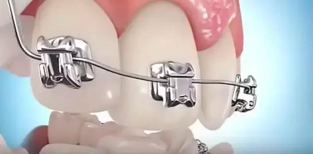 箍牙的牙套是怎么固定上去的,箍牙齿全过程图片