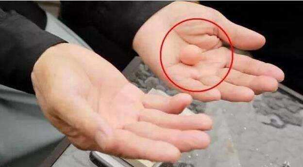 腹部有个小疙瘩要不要做手术,腹部恶性包块有转移可以切除吗