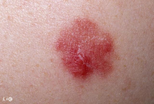 丘疹怎么护理才好得快,丘疹需要关注的饮食