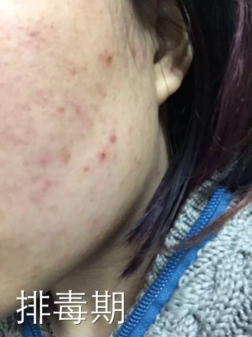 慎入！春季多发激素脸！你还要不要脸？