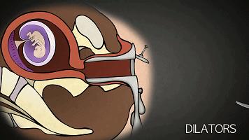 堕胎手术有多可怕,做了堕胎手术