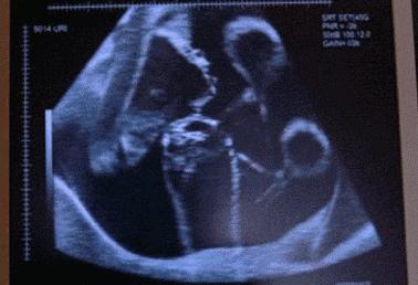 37岁孕妇意外怀孕两个月,25岁孕妇意外怀孕双胞胎