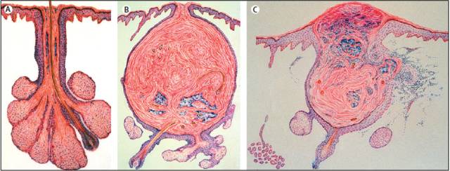 痘疮最好的治疗方法,疮痘是什么