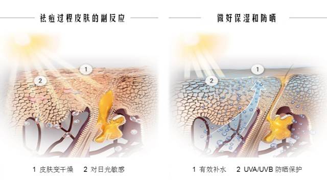 痘疮最好的治疗方法,疮痘是什么