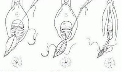 侧切妈妈自述侧切后因为自己的大意所遭受的种种痛苦，望引以为戒