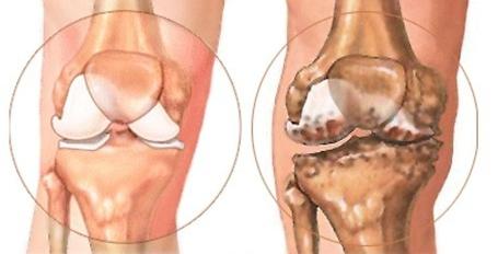 退行性关节炎应该如何治疗