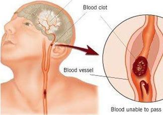 血管老化快寿命就短吗,血管特别细寿命就会短吗