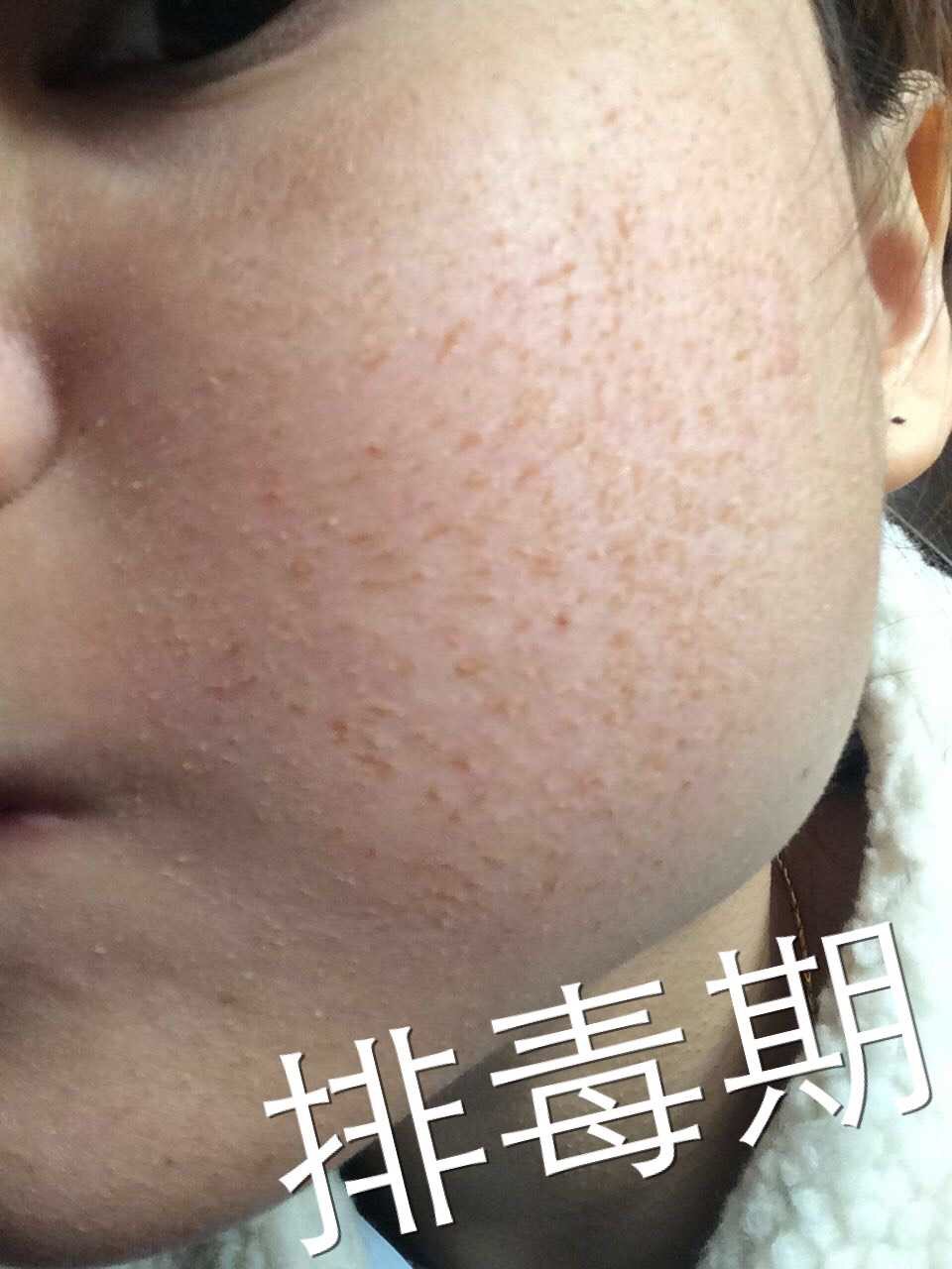 慎入！春季多发激素脸！你还要不要脸？