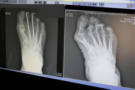 姑娘们，别让高跟鞋毁了你的双脚