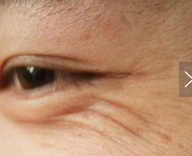 怎么去眼袋和皱纹的最有效方法,去皱纹抗衰老最有效方法