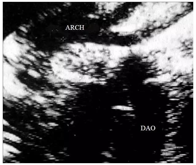 超声主动脉瓣重度狭窄,主动脉弓闭锁