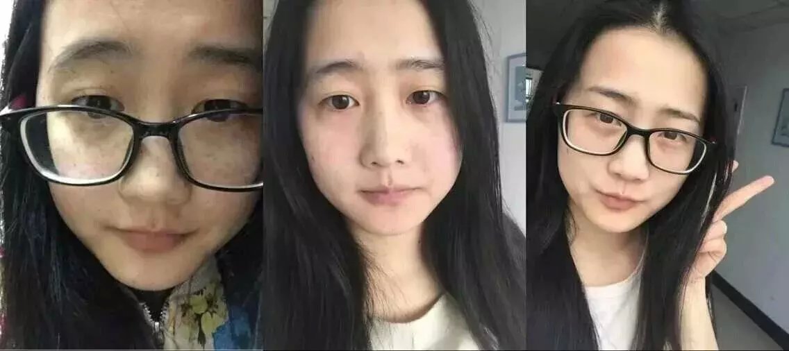 还在为整形而烦恼吗,千万别步入祛斑误区