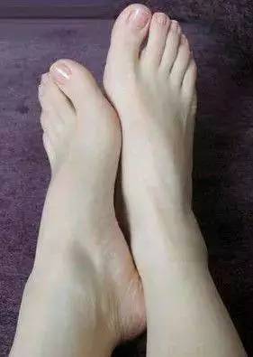 脚外侧老茧去除小窍门,脚上有老皮老茧怎么去除