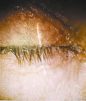 男子误把502胶水滴进眼睛里,502胶水误当眼药水视频