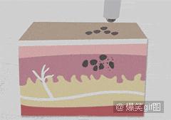 这样的文身，女孩涂后红疹起泡留疤都来了，你还敢玩吗？