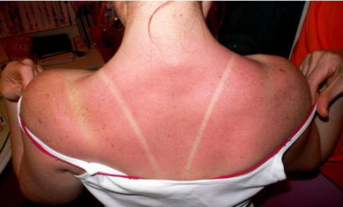 不谨慎被晒黑了怎么办,夏天被晒得肤色不均匀怎么办